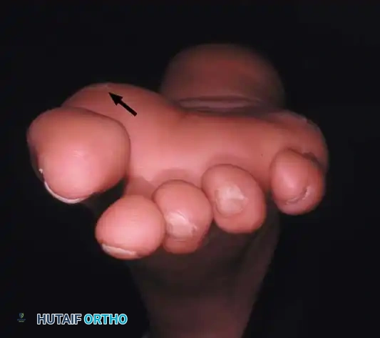 SESAMOID INJURIES OF THE HALLUX Surgical Diagram