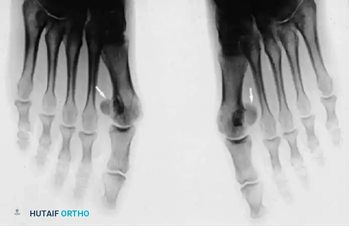 SESAMOID INJURIES OF THE HALLUX Surgical Diagram