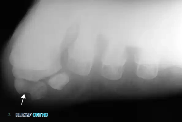 Fig. 78-101 Axial sesamoid view showing fracture of tibial sesamoid.