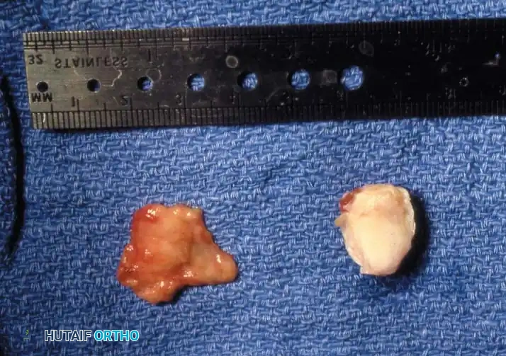 Fig. 78-103 A and B, Persistent keratotic lesion and bursa beneath tibial sesamoid. C, Sesamoid and overlying bursa removed. Radiographs, including axial sesamoid view, were normal.