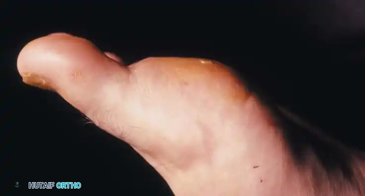 Fig. 78-103 A and B, Persistent keratotic lesion and bursa beneath tibial sesamoid. C, Sesamoid and overlying bursa removed. Radiographs, including axial sesamoid view, were normal.