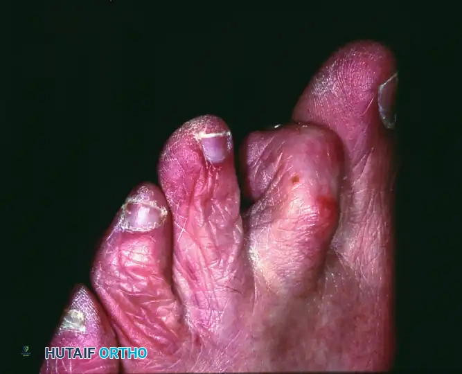 SHORTENING METATARSAL (WEIL) OSTEOTOMY Surgical Diagram