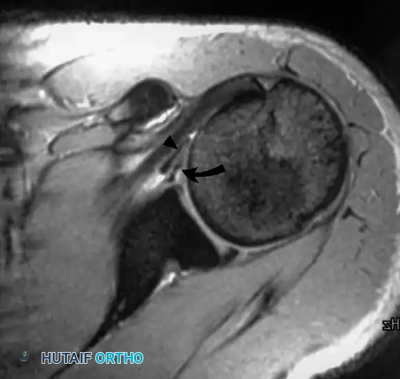صورة رنين مغناطيسي محوري مع حقن صبغة تباين تظهر الشفا الغضروفي الأمامي والخلفي