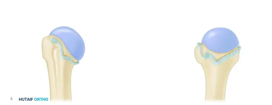 صورة توضح آلية عمل الرباط السفلي كأرجوحة داعمة للكتف