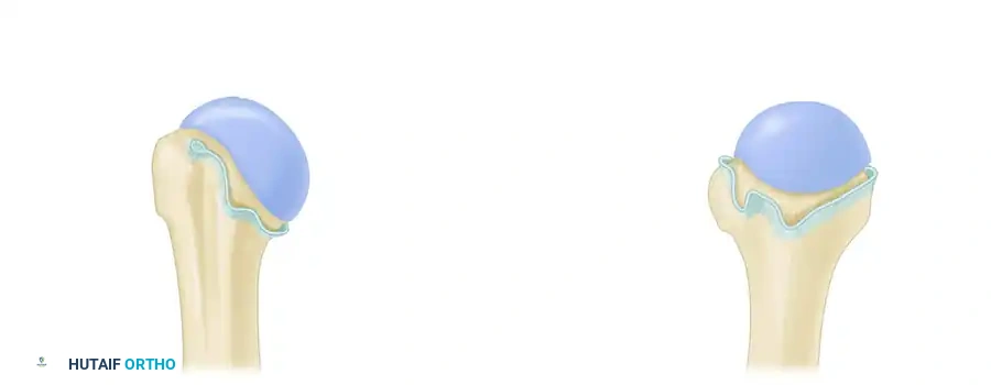 صورة إضافية تظهر توتر الأربطة أثناء حركة الكتف