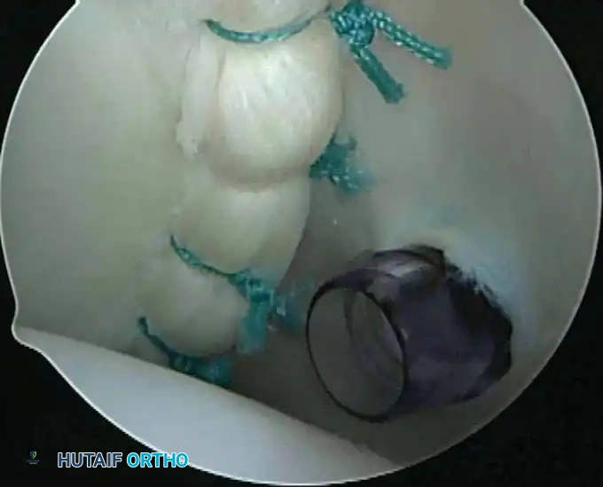 Arthroscopic knot tying
