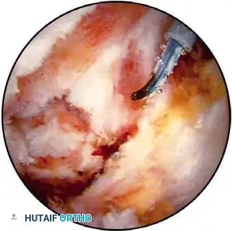 Electrocautery for hemostasis