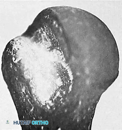 FIGURE 61-13 Pseudoarticulation (arrows) of humeral head with anterior aspect of glenoid cavity in chronic anterior dis­ location of shoulder. A, Acromion; C, coracoid process. (From Kirt­ land S, Resnick D, Sartoris D, et al: Chronic, unreduced dislocations of the glenohumeral joint: imaging strategy and pathologic correlation, J Trauma 28:1622, 1988.)