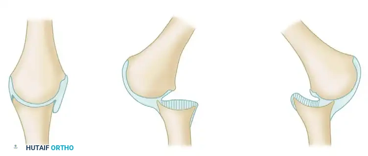 FIGURE 61-11 Relationships in unreduced dislocations of shoulder. A, Normal relationship of humeral head and glenoid cavity. B, In old anterior dislocation, adhesions of posterior capsule to glenoid surface develop. C, In old posterior dis­location, adhesions of anterior capsule to glenoid surface develop. (From Neviaser JS: Arthrography of the shoulder: the diagnosis and management of the lesions visualized , Springfield, IL, 1975, Charles C Thomas.)