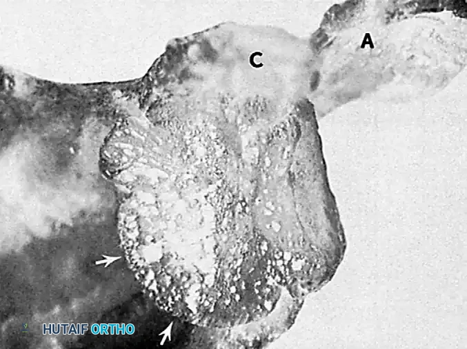 FIGURE 61-12 Large wedge-shaped defect in posterolateral aspect of humeral head in chronic anterior dislocation. (From Kirtland S, Resnick D, Sartoris D, et al: Chronic, unreduced dislocations of the glenohumeral joint: imaging strategy and pathologic correlation, J Trauma 28:1622, 1988.)