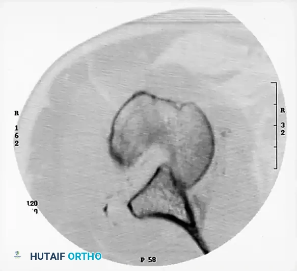 FIGURE 61-10 CT scan showing extent of damage to articular surface of glenoid head.