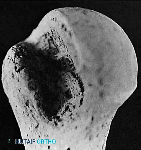 Mastering the Management of Chronic Unreduced Shoulder Dislocations