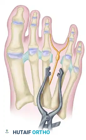 SIGNS AND SYMPTOMS Surgical Diagram