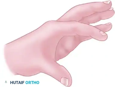 Thumb Web Space Z-Plasty: Surgical Techniques & Protocols