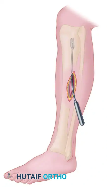 Anterolateral intermuscular septum