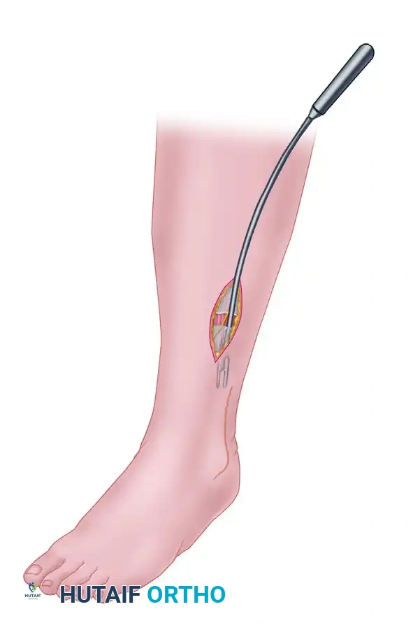 Anterolateral intermuscular septum