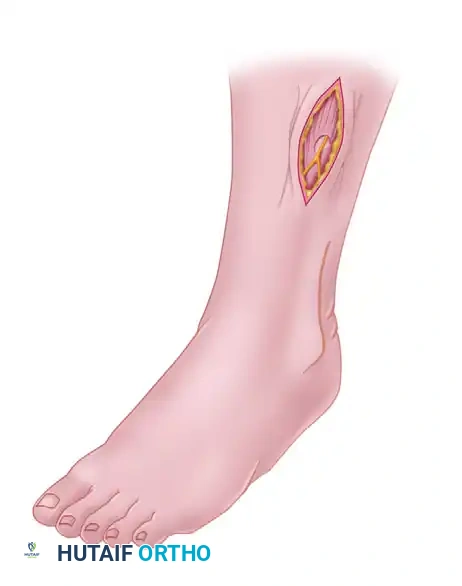 Anterolateral intermuscular septum