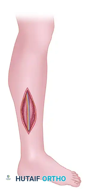 Leg Compartment Syndrome: Single and Double-Incision Fasciotomy Techniques