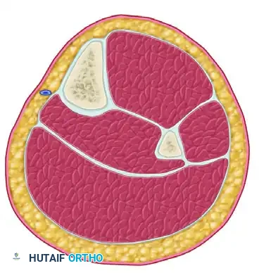 SINGLE-INCISION FASCIOTOMY Surgical Diagram