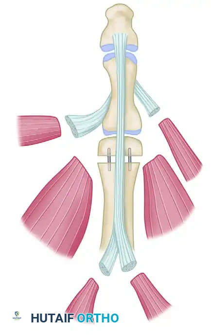 Single-Stage Great Toe-to-Thumb Transfer: Comprehensive Surgical Guide