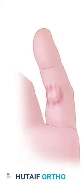 Area scar on the digit