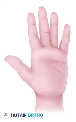 Flexion contracture caused by linear scar