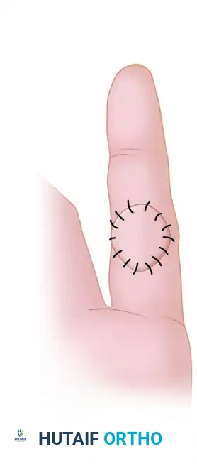 Full-thickness skin graft replacing area scar