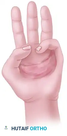 Palmar area scar replaced by graft following incision rules