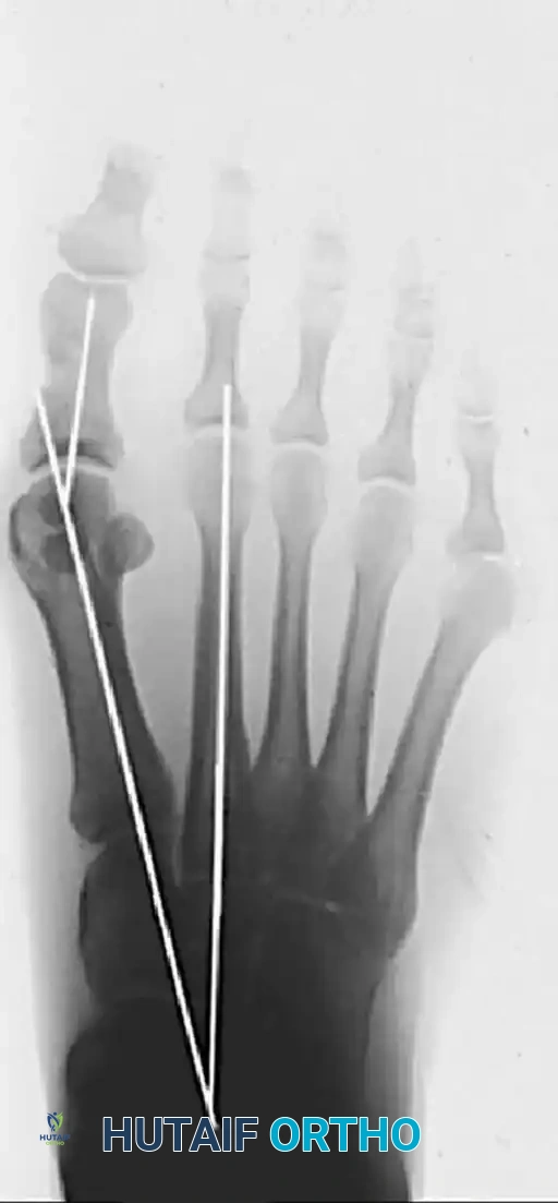 Method of measuring hallux valgus angle and intermetatarsal angle. Center points are connected, and intersecting lines define angles.