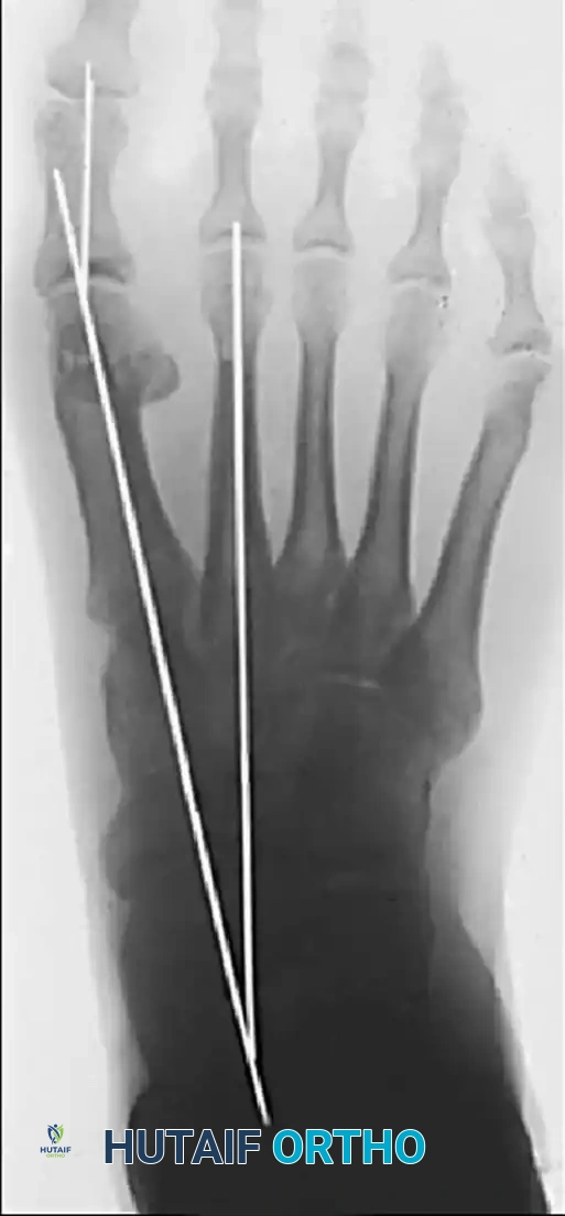 Postoperative closure demonstrating excellent alignment of the hallux.