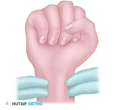 Management of Arterial Thrombosis and Special Vascular Disorders of the Hand