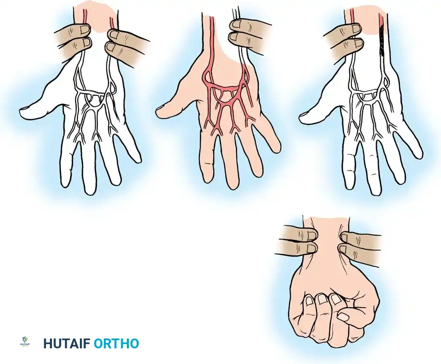 Special Hand Disorders Surgical Diagram