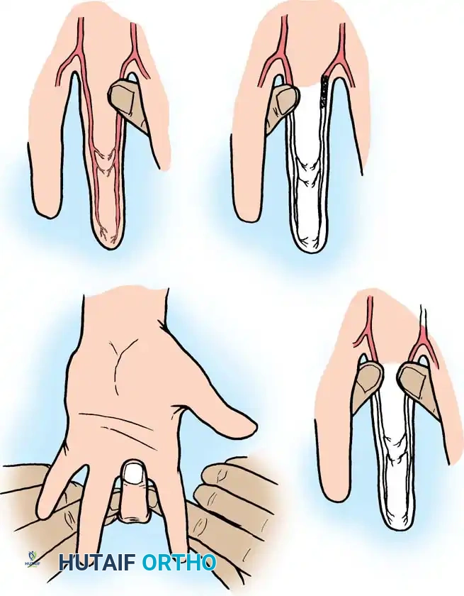 Special Hand Disorders Surgical Diagram
