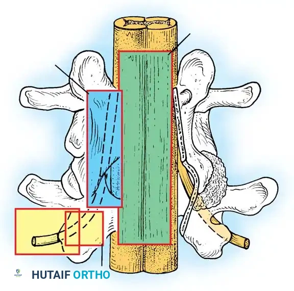 SPINAL STENOSIS Surgical Diagram