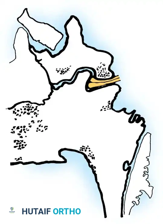 SPINAL STENOSIS Surgical Diagram