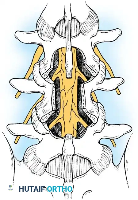 SPINAL STENOSIS Surgical Diagram