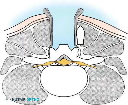 SPINAL STENOSIS Surgical Diagram