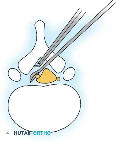SPINAL STENOSIS Surgical Diagram