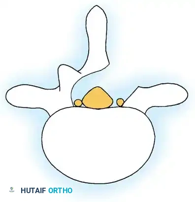 SPINAL STENOSIS Surgical Diagram