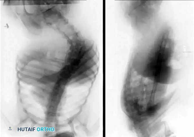 Fig. 30-43 A, Posteroanterior view of spine of patient with spastic quadriplegic cerebral palsy with 73-degree thoracolumbar scoliosis and pelvic obliquity. B, Lateral view of spine of same patient shows progressive lumbar lordosis. This deformity was believed to contribute to increased skin pressures and seating difﬁ culties. (From McCarthy JJ, D’Andrea LP, Betz RR, et al: Scoliosis in the child with cerebral palsy, J Am Acad Orthop Surg 14:367, 2006.)