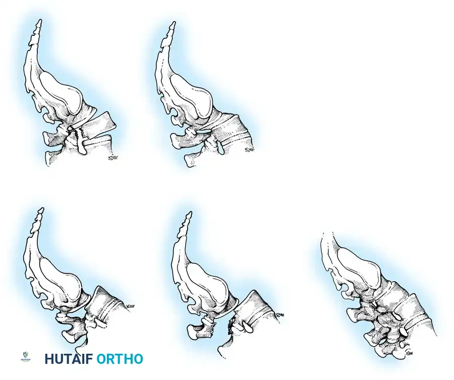 SPONDYLOLYSIS AND SPONDYLOLISTHESIS Surgical Diagram