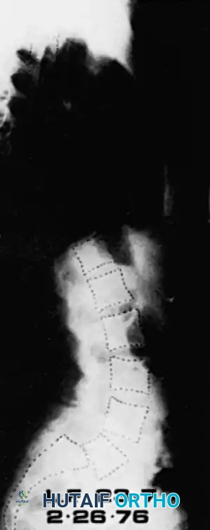 SPONDYLOLYSIS AND SPONDYLOLISTHESIS Surgical Diagram