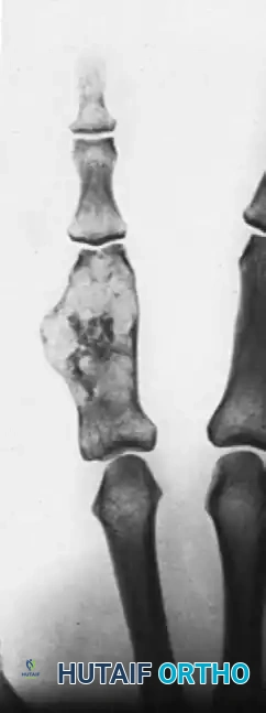 SQUAMOUS CELL CARCINOMA Surgical Diagram