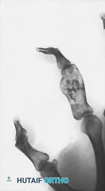 SQUAMOUS CELL CARCINOMA Surgical Diagram