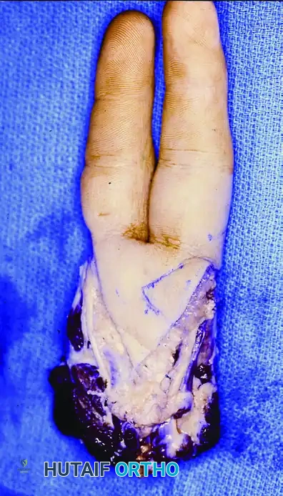SQUAMOUS CELL CARCINOMA Surgical Diagram