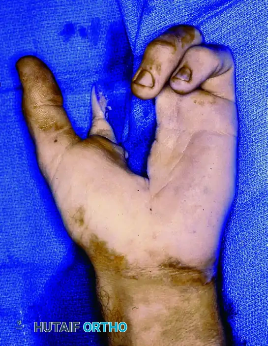 SQUAMOUS CELL CARCINOMA Surgical Diagram