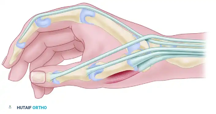 In rare cases, abductor pollicis longus inserts on fascia of abductor pollicis brevis