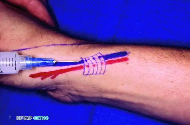 Often, abductor pollicis longus inserts on the trapezium and base of first metacarpal through two tendons.