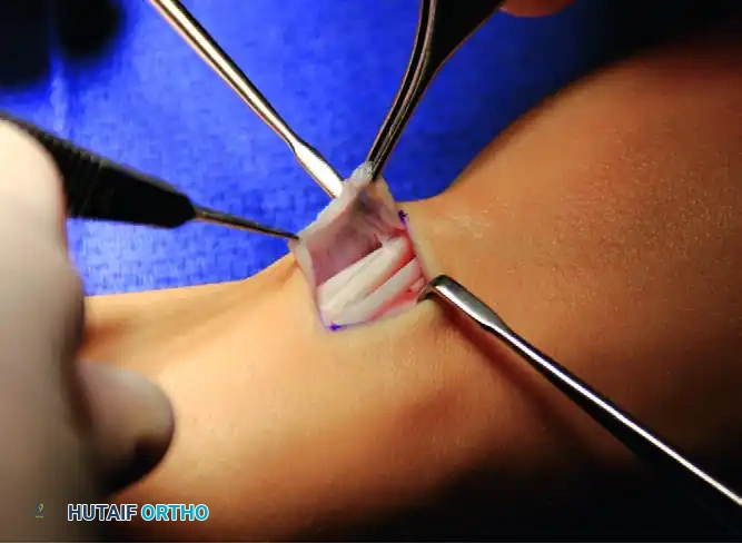 First dorsal compartment has been opened on its ulnar side