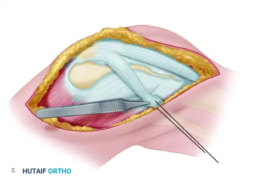 Strip is attached at lateral tibial tubercle by suture to periosteum or through bony tunnel